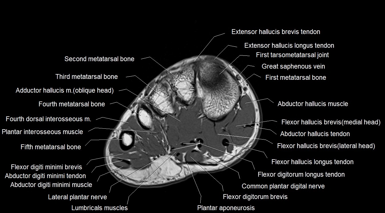 MRI 3T foot axial cross sectional anatomy image 14.webp